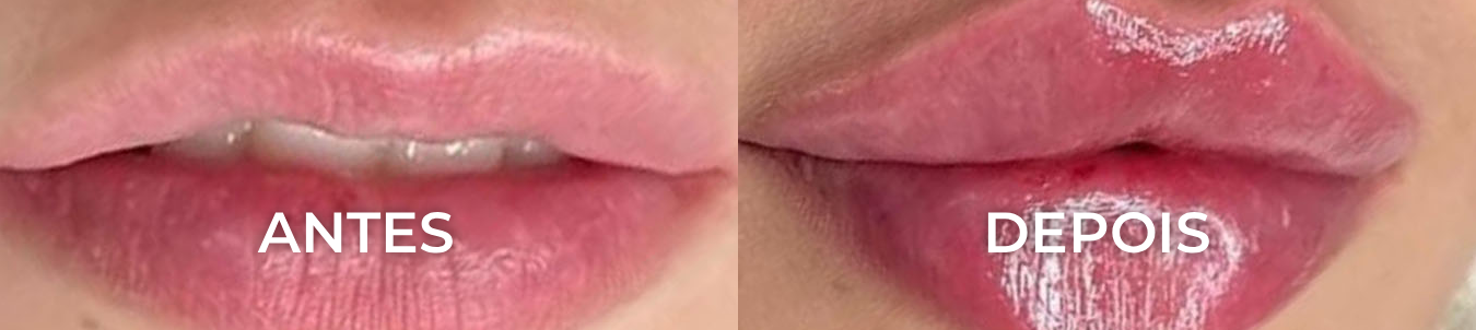 ANTES E DEPOIS Non-Surgical Facial Rejuvenation